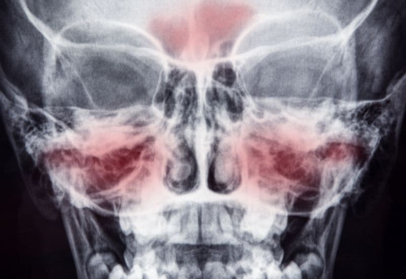 Xoang là những hốc xương rỗng, nằm trong khối xương sọ mặt, cụ thể là nằm xung quanh hốc mũi và thông với hốc mũi. Tương tự hốc mũi, các hốc xương rỗng này được bao phủ bởi một lớp niêm mạc, gọi là niêm mạc đường hô hấp.