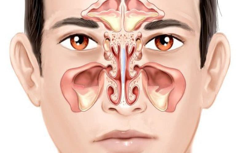 Người bệnh bị viêm xoang mũi