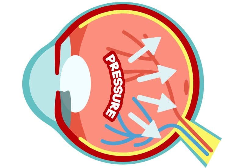 Nếu cấu trúc dẫn lưu không hoạt động bình thường vì nguyên nhân nào đó, thủy dịch không thoát hoặc thoát khỏi nhãn cầu rất chậm, nhãn áp sẽ tăng, gây bệnh glocom.
