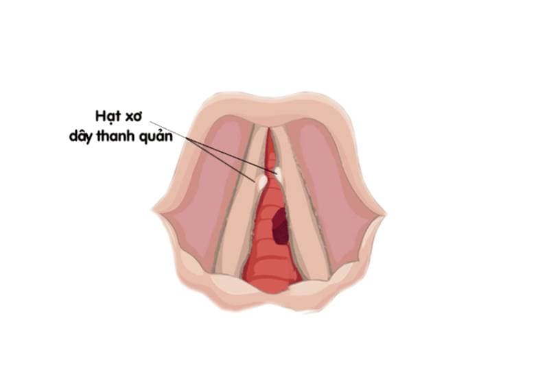 Cắt hạt xơ dây thanh kiêng nói bao lâu
