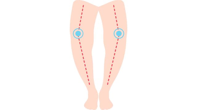 Trẻ còi xương: Những nguyên tắc điều trị cốt lõi