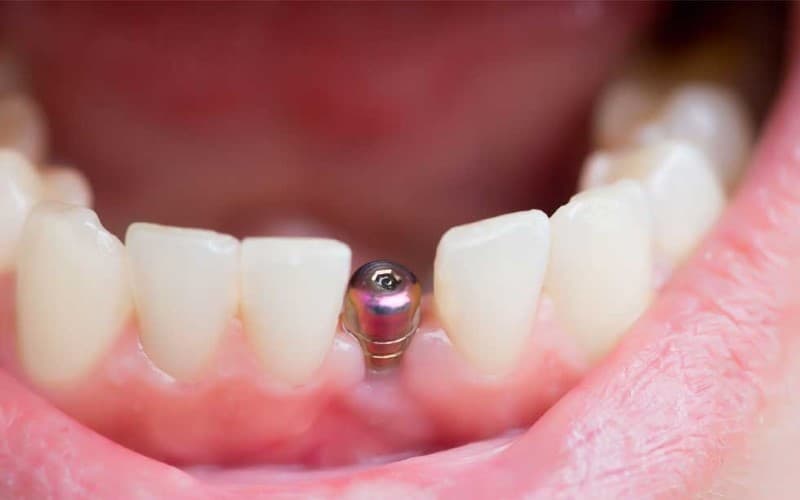 Trồng răng Implant