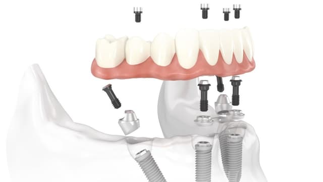 Những lưu ý khi thực hiện kỹ thuật trồng răng Implant