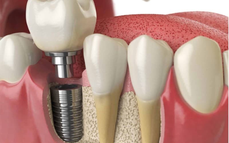 Lưu ý kỹ thuật trồng răng Implant