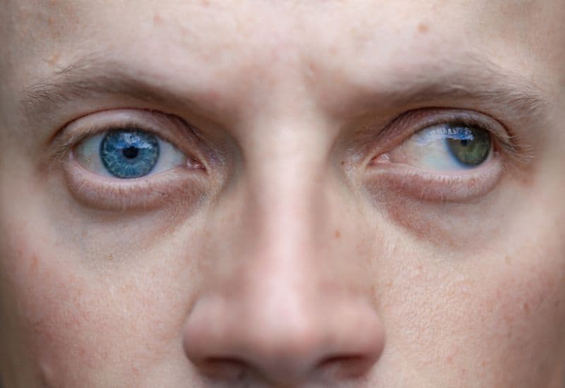 Người mắt lác thường xuyên nheo mắt, nhăn mặt, nghiêng đầu, nhìn một vật bằng cách che một mắt, nhạy cảm với ánh sáng, mắt đỏ, nhức đầu…