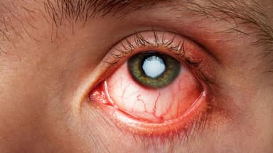 Nguyên nhân đau mắt đỏ phổ biến: Biết để dự phòng