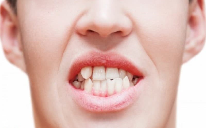Răng mọc lệch