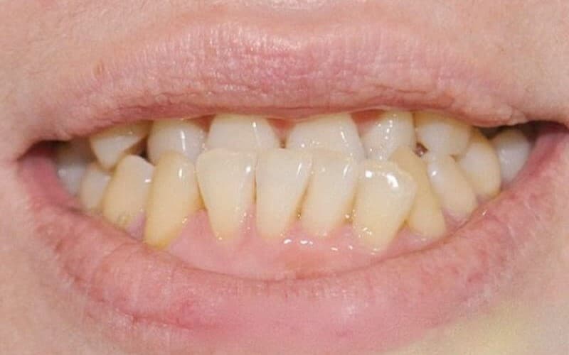 Tình trạng cần nhổ răng mọc lệch