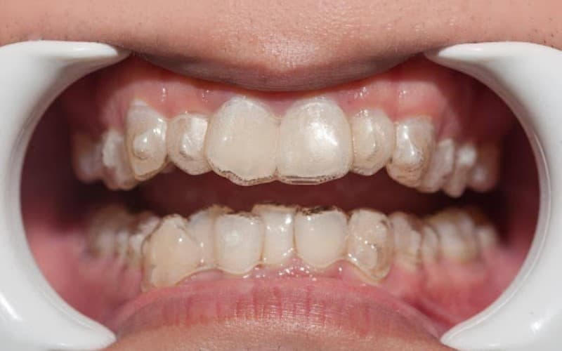 Thực hiện niềng răng trong suốt Invisalign