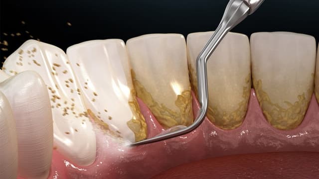 Giải đáp về độ an toàn của các phương pháp loại bỏ cao răng