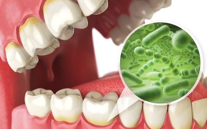 Răng dễ bị sâu