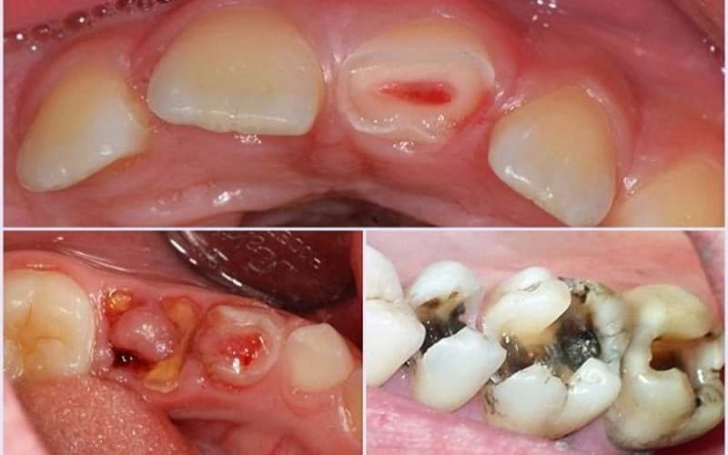 Ảnh hưởng khi răng sâu bị lồi thịt