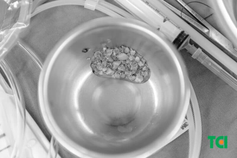 Xử trí sỏi lớn tái phát nằm trong thận mang sẹo bằng tán sỏi qua da