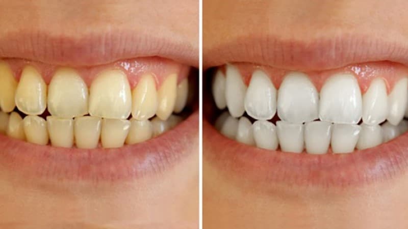 Tẩy trắng răng có hại gì không