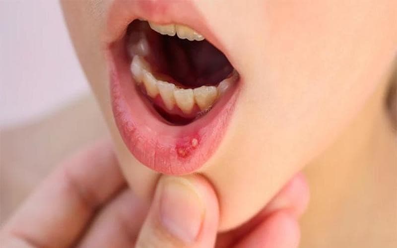 Sử dụng thuốc nhiệt miệng