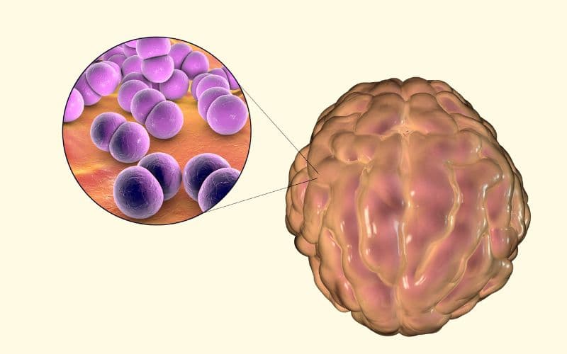VMNMC có giai đoạn đầu khó để phát hiện vì triệu chứng thường xuất hiện đột ngột, bao gồm đau đầu, sốt, buồn nôn - tiêm vacxin cho bé