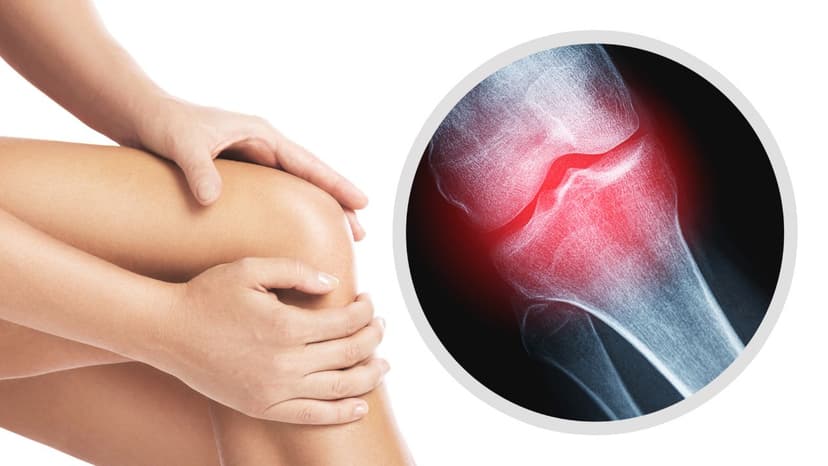 Tìm hiểu bệnh viêm khớp gối là gì