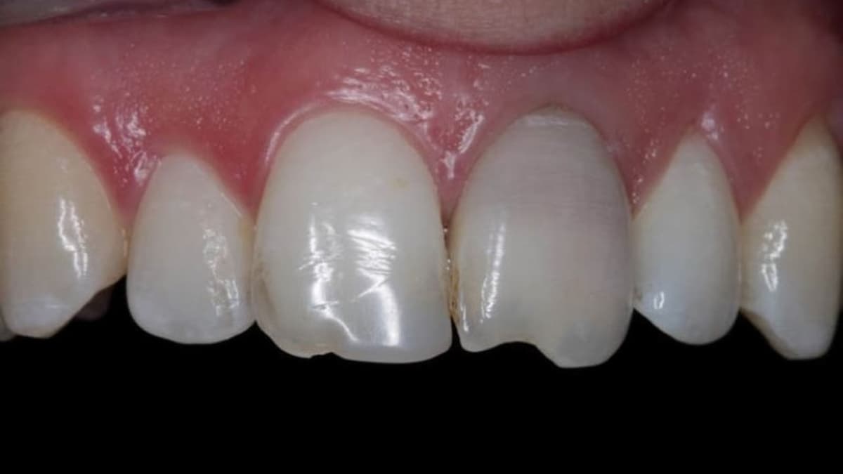 Trám răng cửa bị sâu có đau không và những lưu ý