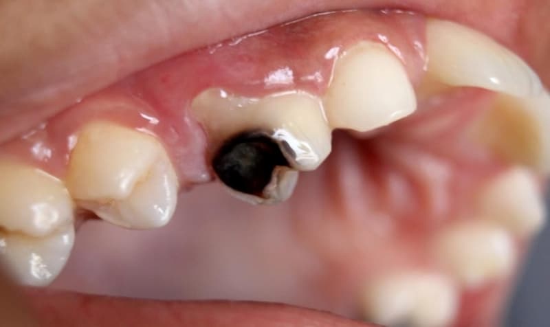 Phương pháp trám răng sâu lỗ to