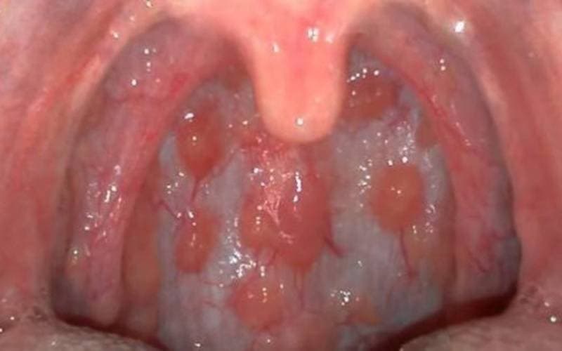 Viêm họng hạt có dấu hiệu gì