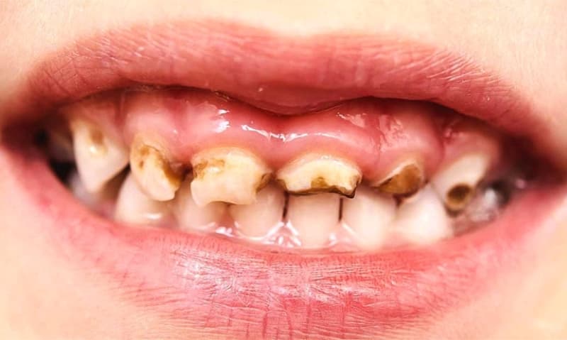 Sâu răng sưng lợi răng cửa