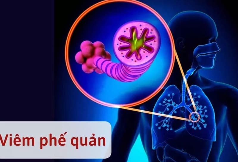 Viêm phế quản cấp j20 là gì?