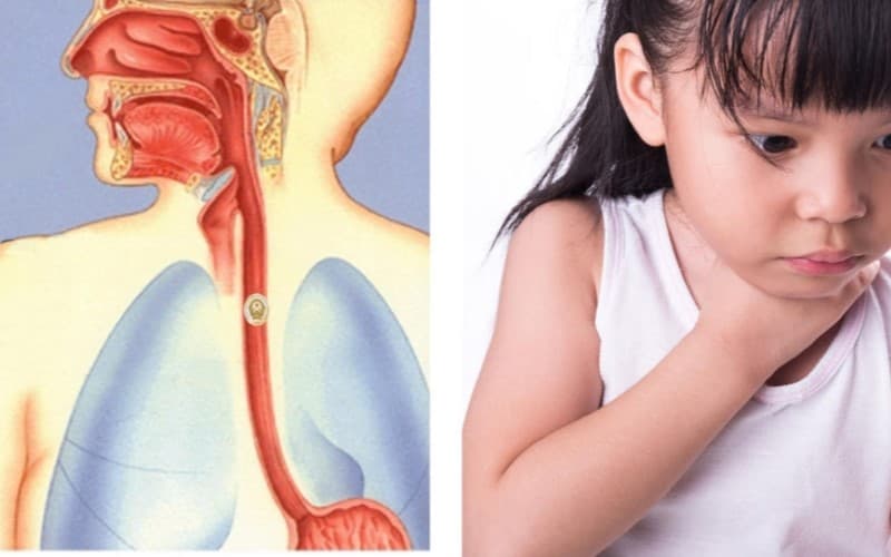 Tình trạng hóc dị vật đường thở
