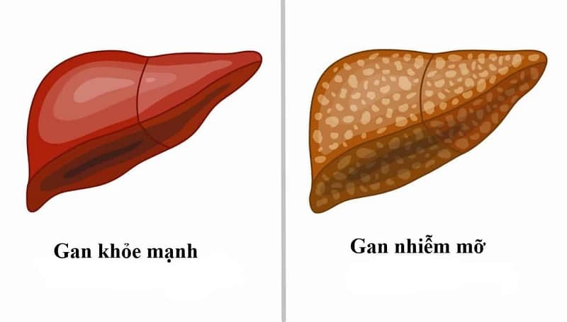 Livosil 140mg có tác dụng gì trong điều trị bệnh gan?