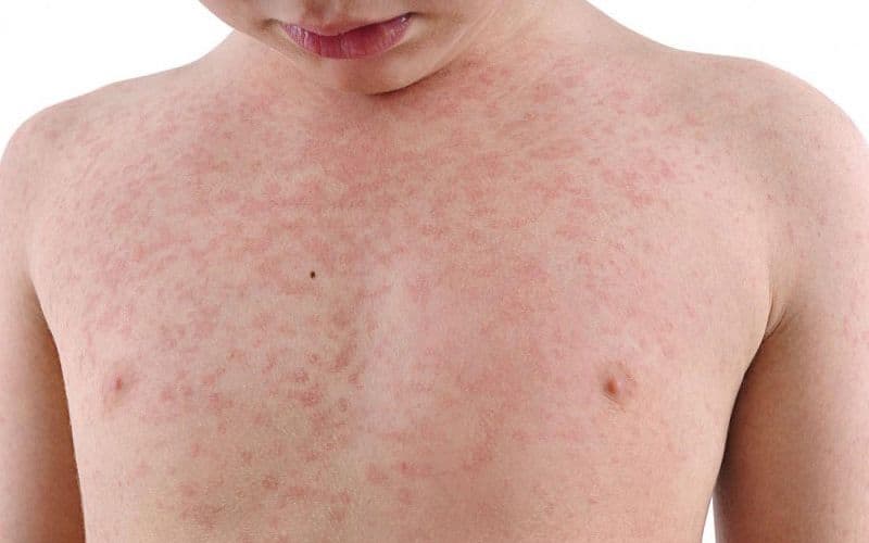 Cẩn trọng với các tác dụng phụ của thuốc