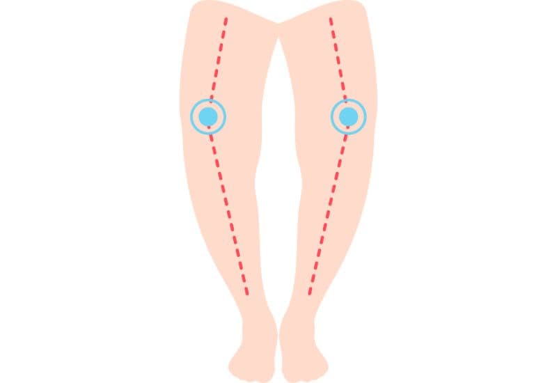 Biến dạng xương là hệ lụy phổ biến nhất của bệnh còi xương ở trẻ em.