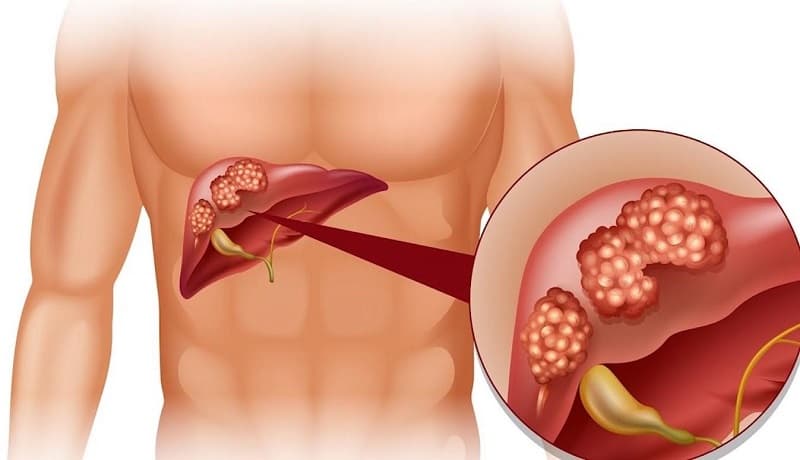 Bệnh gan gây ảnh hưởng đến hoạt động của cơ thể.
