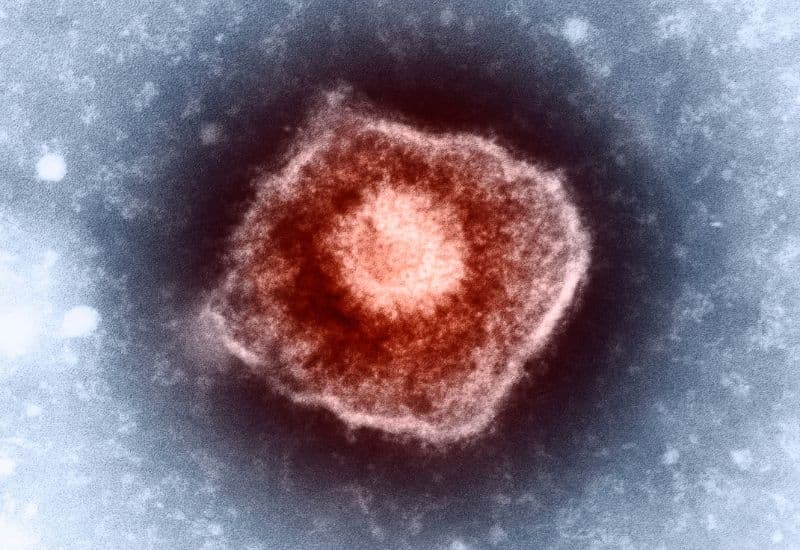 Nguyên nhân phát sinh thủy đậu trong trường hợp nào cũng là virus varicella-zoster.