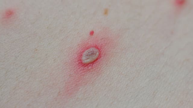 Bệnh thủy đậu ở trẻ em dưới 1 tuổi: Cẩn trọng nguy cơ tử vong