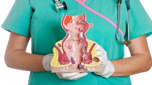 Tìm hiểu các phương pháp chữa bệnh trĩ phổ biến hiện nay