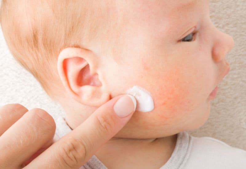 Cách sử dụng Latopic Face and Body Cream hỗ trợ điều trị chàm sữa