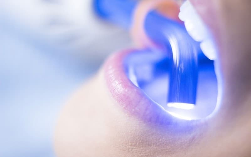 Thực hiện cách tẩy trắng răng