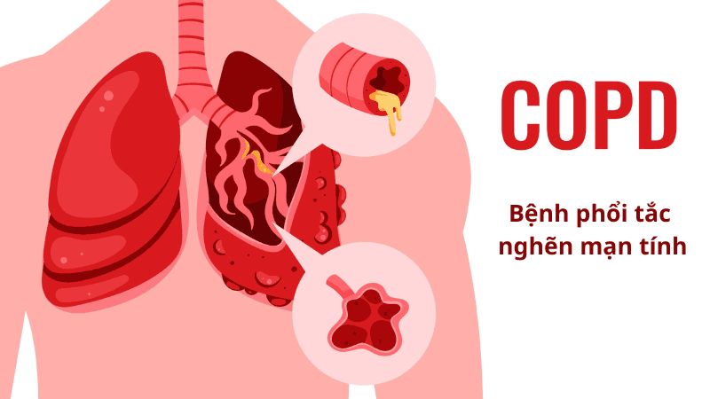 COPD là bệnh gì?