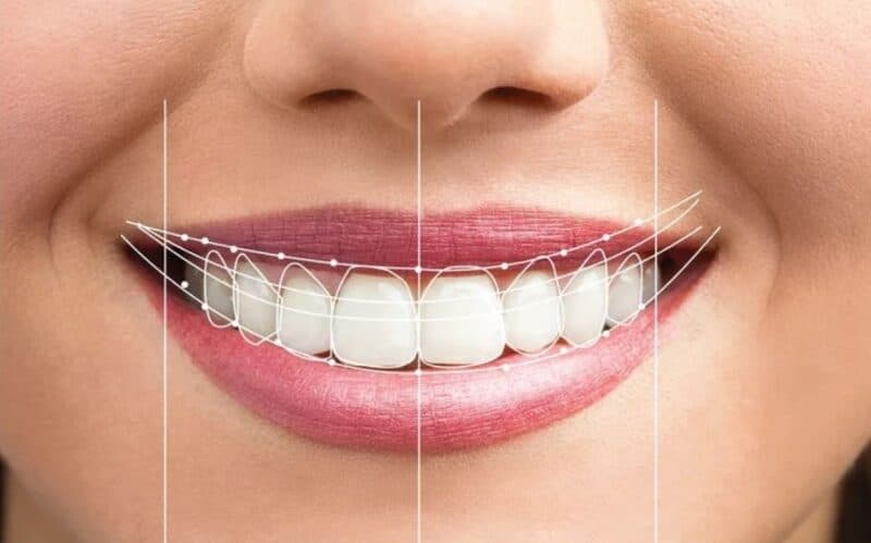 Khắc phục cười bị hở lợi