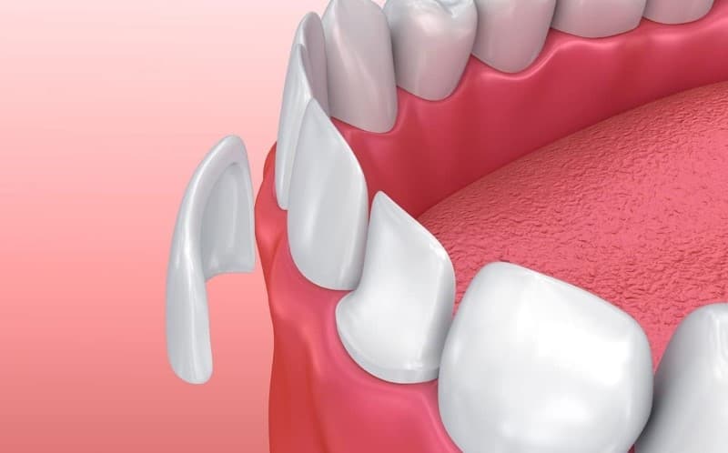 Có nên dán sứ Veneer 2 răng cửa