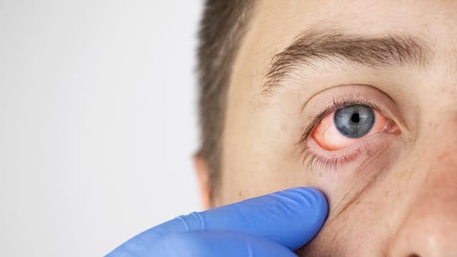 Đau mắt đỏ có bị lây không, giải đáp của chuyên gia