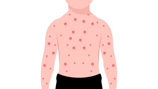 Đậu mùa: Thông tin có thể bố mẹ chưa biết