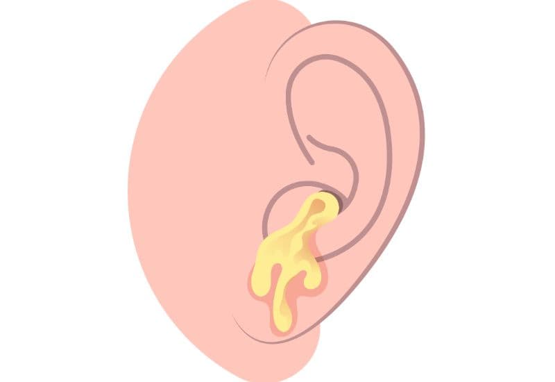 Tai bao gồm tai ngoài, tai giữa, tai trong; trong đó, tai giữa nằm phía sau màng nhĩ, lại bao gồm hòm tai, vòi nhĩ (vòi nối tai giữa và mũi họng) và sào bào (tế bào lớn nhất trong xương chũm)