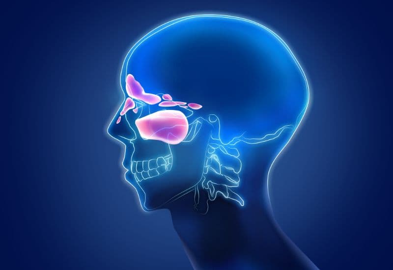 Viêm xoang là tình trạng viêm niêm mạc xoang, xuất hiện khi tại niêm mạc xoang có sự xâm nhập của các tác nhân gây hại, chủ yếu là vi khuẩn, virus, nấm và các dị nguyên. 