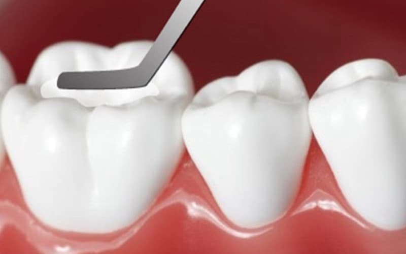 Tình trạng hàn răng bị vỡ