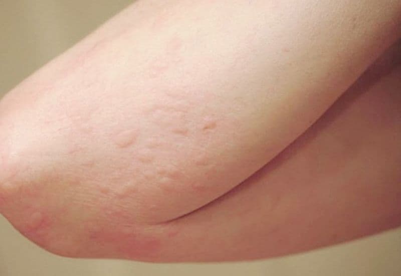 Đối tượng sử dụng thuốc Levocetirizine