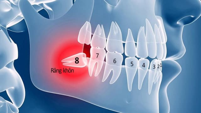 Có nên nhổ răng khôn mọc lệch và lưu ý thực hiện