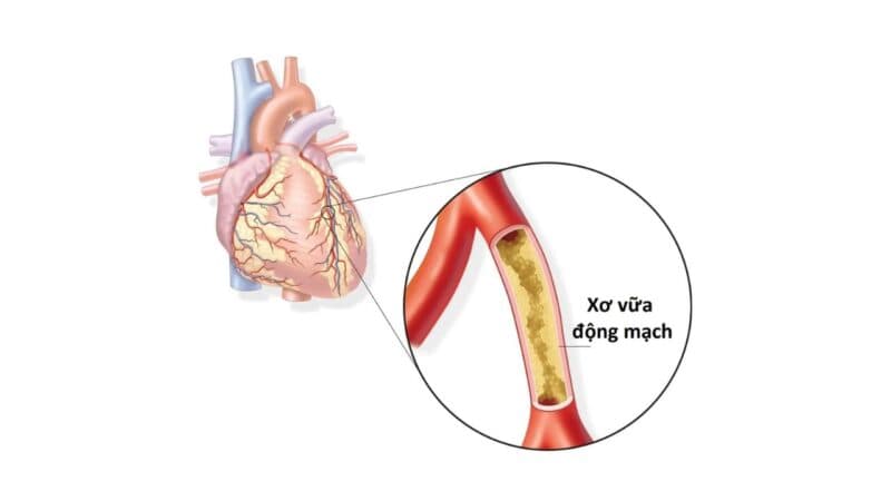 Ridlor 75mg được sử dụng chủ yếu để kiểm soát và dự phòng thứ phát đối với bệnh xơ vữa động mạch