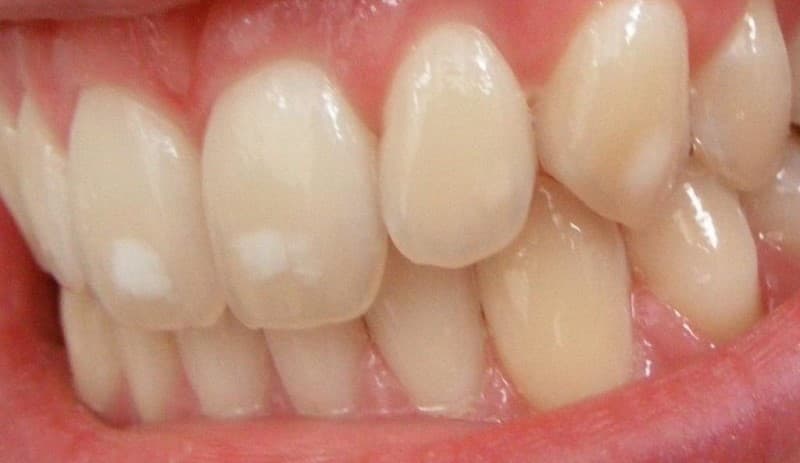 Tình trạng sâu răng giai đoạn đầu