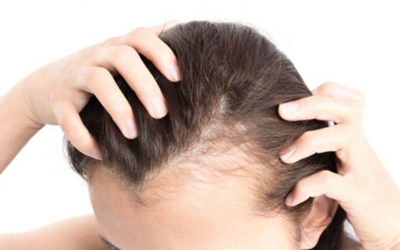 Lạm dụng steroid có thể gây rụng tóc - steroid là gì