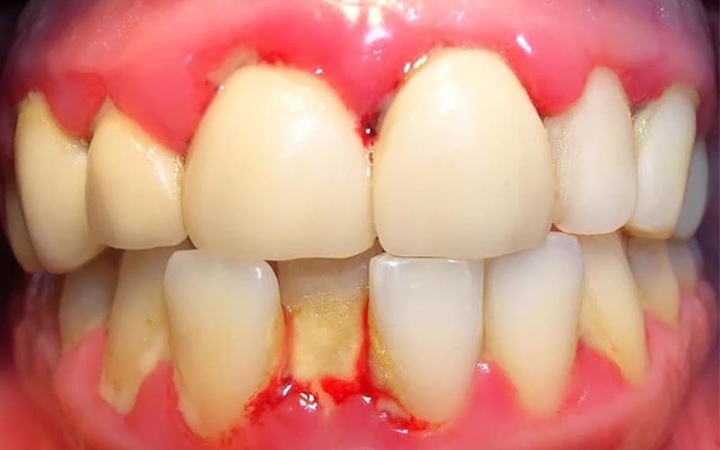 Biểu hiện viêm lợi trùm răng cửa